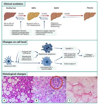 Liver Fibrosis in Non-alcoholic Fatty Liver Disease: From Liver Biopsy to Non-invasive Biomarkers in Diagnosis and Treatment